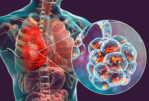 Legionnaires disease caused by low stored hot water temperatures in hot water cylinders in the UK